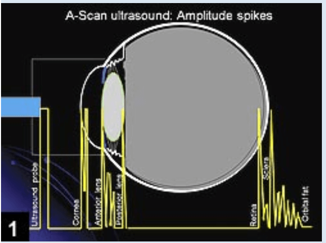 Biom&eacute;trie &eacute;chographique A-SCAN